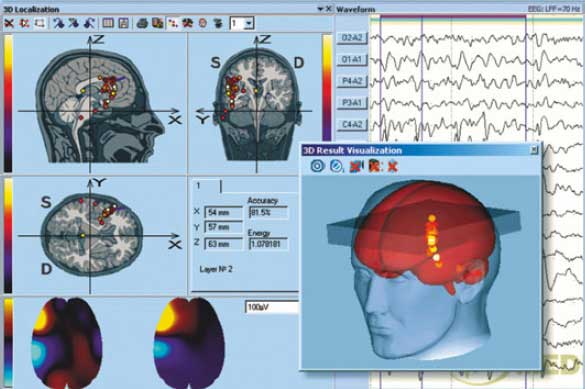 software 3D Encephalan EEG